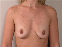 Breast Augmentation Before Photo by Robert Zubowski, MD; Paramus, NJ - Case 23558