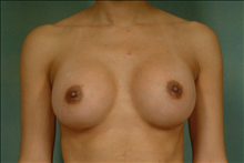 Breast Augmentation After Photo by Robert Zubowski, MD; Paramus, NJ - Case 23559