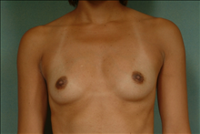 Breast Augmentation Before Photo by Robert Zubowski, MD; Paramus, NJ - Case 23559