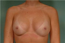 Breast Augmentation After Photo by Robert Zubowski, MD; Paramus, NJ - Case 23685
