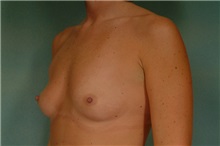 Breast Augmentation Before Photo by Robert Zubowski, MD; Paramus, NJ - Case 23685