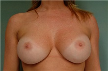 Breast Augmentation After Photo by Robert Zubowski, MD; Paramus, NJ - Case 23686
