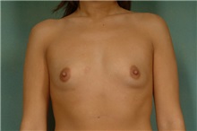 Breast Augmentation Before Photo by Robert Zubowski, MD; Paramus, NJ - Case 23687