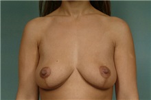 Breast Lift After Photo by Robert Zubowski, MD; Paramus, NJ - Case 23690