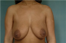 Breast Lift Before Photo by Robert Zubowski, MD; Paramus, NJ - Case 23690