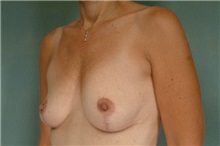 Breast Lift After Photo by Robert Zubowski, MD; Paramus, NJ - Case 23692