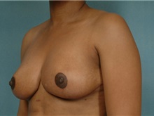 Breast Reduction After Photo by Robert Zubowski, MD; Paramus, NJ - Case 23697