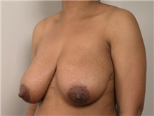 Breast Reduction Before Photo by Robert Zubowski, MD; Paramus, NJ - Case 23697