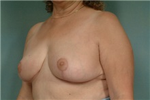Breast Reduction After Photo by Robert Zubowski, MD; Paramus, NJ - Case 23698