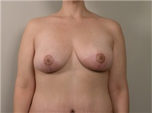 Breast Lift After Photo by Robert Zubowski, MD; Paramus, NJ - Case 23701