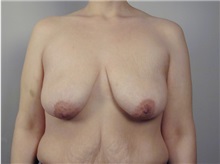 Breast Lift Before Photo by Robert Zubowski, MD; Paramus, NJ - Case 23701