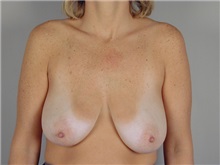 Breast Lift Before Photo by Robert Zubowski, MD; Paramus, NJ - Case 23702