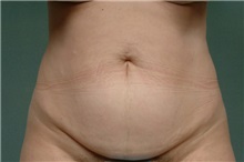 Tummy Tuck Before Photo by Robert Zubowski, MD; Paramus, NJ - Case 23703
