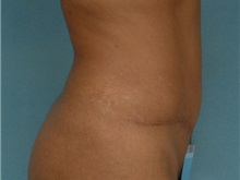 Tummy Tuck After Photo by Robert Zubowski, MD; Paramus, NJ - Case 23705