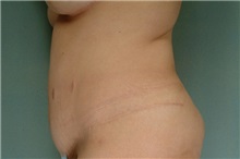Tummy Tuck After Photo by Robert Zubowski, MD; Paramus, NJ - Case 23707