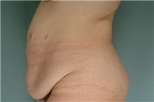 Tummy Tuck Before Photo by Robert Zubowski, MD; Paramus, NJ - Case 23707