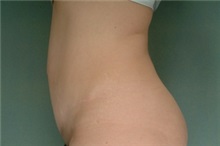 Tummy Tuck After Photo by Robert Zubowski, MD; Paramus, NJ - Case 23708