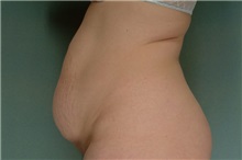 Tummy Tuck Before Photo by Robert Zubowski, MD; Paramus, NJ - Case 23708