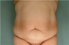 Tummy Tuck Before Photo by Robert Zubowski, MD; Paramus, NJ - Case 23709