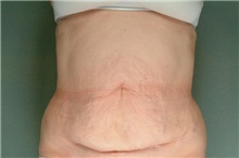 Tummy Tuck Before Photo by Robert Zubowski, MD; Paramus, NJ - Case 23711