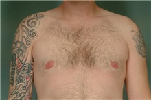 Male Breast Reduction After Photo by Robert Zubowski, MD; Paramus, NJ - Case 23731