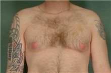 Male Breast Reduction Before Photo by Robert Zubowski, MD; Paramus, NJ - Case 23731