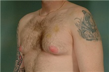 Male Breast Reduction Before Photo by Robert Zubowski, MD; Paramus, NJ - Case 23731