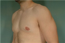 Male Breast Reduction After Photo by Robert Zubowski, MD; Paramus, NJ - Case 23732