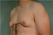 Male Breast Reduction Before Photo by Robert Zubowski, MD; Paramus, NJ - Case 23732