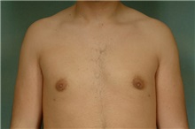 Male Breast Reduction After Photo by Robert Zubowski, MD; Paramus, NJ - Case 23733