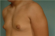Male Breast Reduction Before Photo by Robert Zubowski, MD; Paramus, NJ - Case 23733