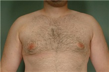 Male Breast Reduction After Photo by Robert Zubowski, MD; Paramus, NJ - Case 23735