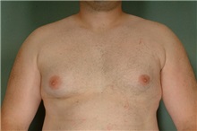 Male Breast Reduction Before Photo by Robert Zubowski, MD; Paramus, NJ - Case 23735