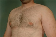 Male Breast Reduction After Photo by Robert Zubowski, MD; Paramus, NJ - Case 23735