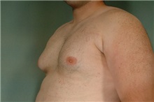 Male Breast Reduction Before Photo by Robert Zubowski, MD; Paramus, NJ - Case 23735