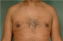 Male Breast Reduction After Photo by Robert Zubowski, MD; Paramus, NJ - Case 23736