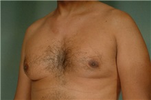 Male Breast Reduction Before Photo by Robert Zubowski, MD; Paramus, NJ - Case 23736