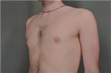 Male Breast Reduction After Photo by Robert Zubowski, MD; Paramus, NJ - Case 23737
