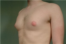 Male Breast Reduction Before Photo by Robert Zubowski, MD; Paramus, NJ - Case 23737
