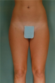 Liposuction Before Photo by Robert Zubowski, MD; Paramus, NJ - Case 23738