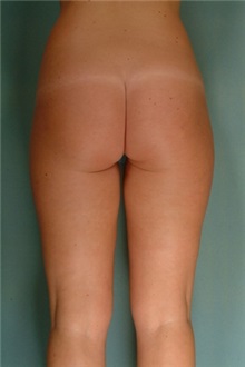 Liposuction After Photo by Robert Zubowski, MD; Paramus, NJ - Case 23738