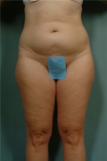 Liposuction Before Photo by Robert Zubowski, MD; Paramus, NJ - Case 23798