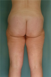 Liposuction After Photo by Robert Zubowski, MD; Paramus, NJ - Case 23798