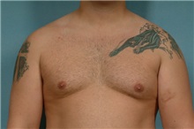 Liposuction Before Photo by Robert Zubowski, MD; Paramus, NJ - Case 23799
