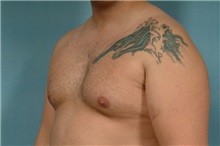 Liposuction After Photo by Robert Zubowski, MD; Paramus, NJ - Case 23799