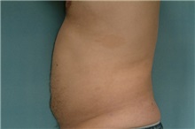 Liposuction After Photo by Robert Zubowski, MD; Paramus, NJ - Case 23800