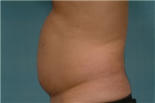 Liposuction Before Photo by Robert Zubowski, MD; Paramus, NJ - Case 23800