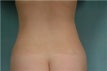 Liposuction After Photo by Robert Zubowski, MD; Paramus, NJ - Case 23801