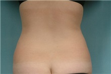 Liposuction Before Photo by Robert Zubowski, MD; Paramus, NJ - Case 23801