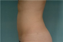 Liposuction After Photo by Robert Zubowski, MD; Paramus, NJ - Case 23801